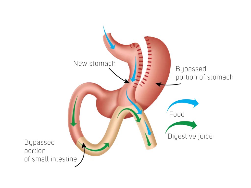 Mini Bypass Salud Bariatrica El Salvador
